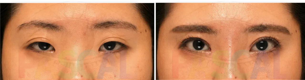 Before and after incisional ptosis correction (before)