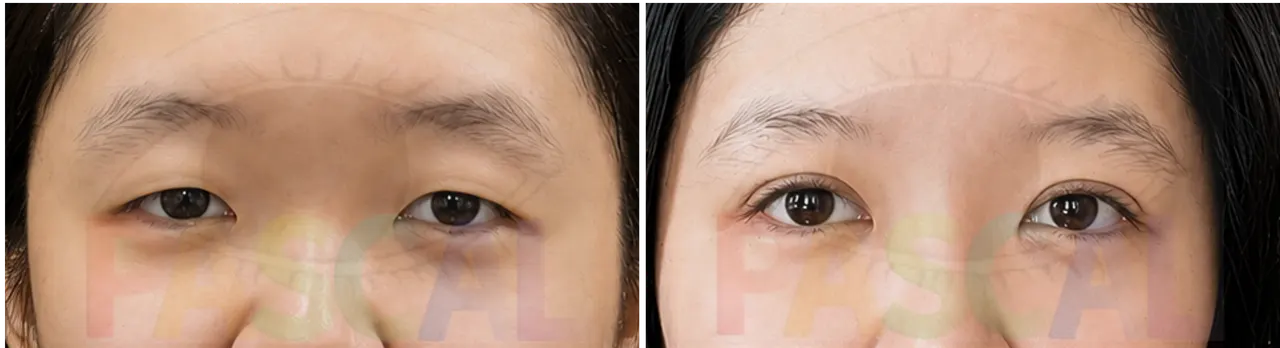 Ptosis correction result at day 5 (before)