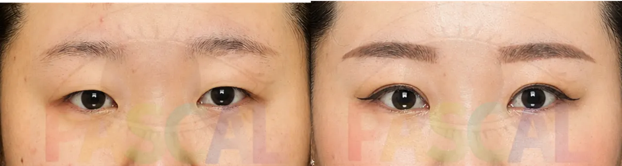 Before and after ptosis correction, second patient (before)