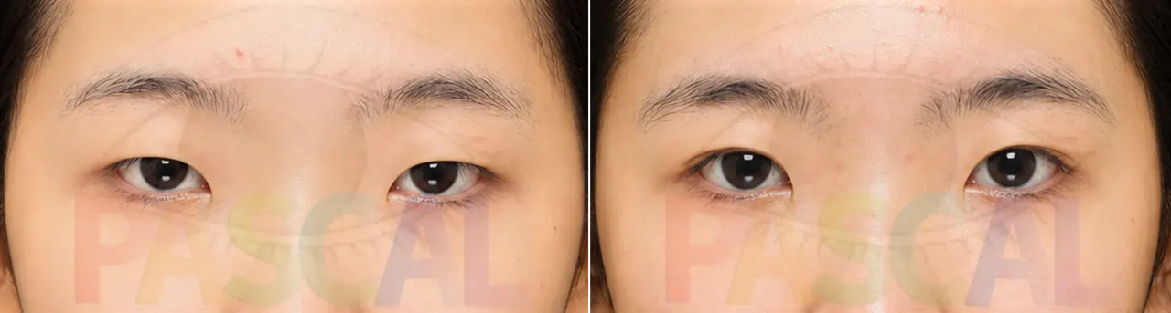 Before and after ptosis correction, third patient (before)
